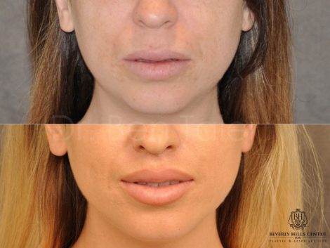 Modified Upper Lip Lift - Front