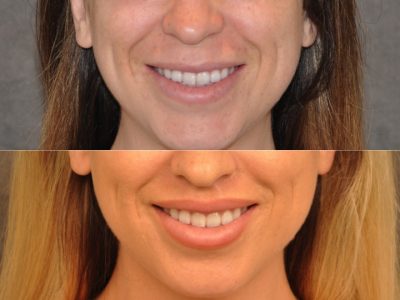 Modified Upper Lip Lift – Front