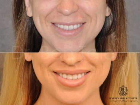 Modified Upper Lip Lift - Front