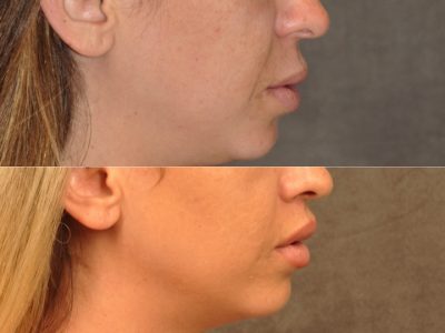 Modified Upper Lip Lift – Right Side