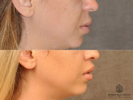 Modified Upper Lip Lift - Right Side