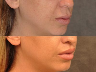 Modified Upper Lip Lift – Right Side
