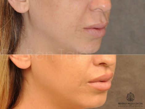 Modified Upper Lip Lift - Right Side