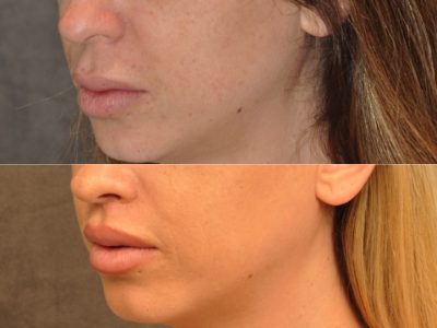 Modified Upper Lip Lift – Left Side