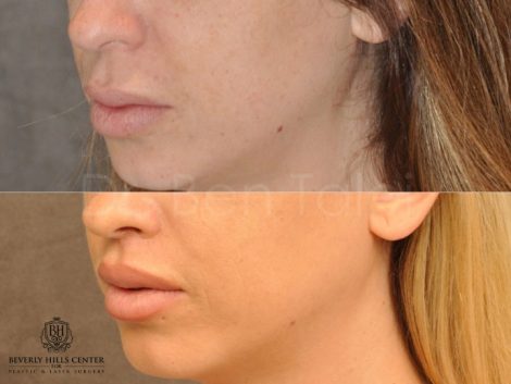 Modified Upper Lip Lift - Left Side