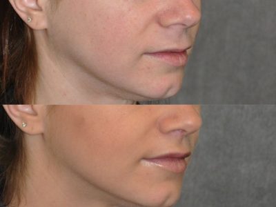 Modified Upper Lip Lift - Right Side