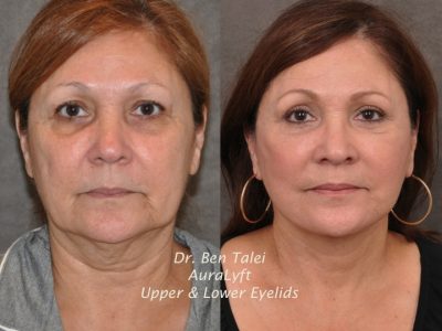 AuraLyft, Upper & Lower Eyelids – Front