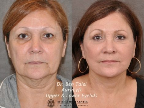 AuraLyft, Upper & Lower Eyelids - Front