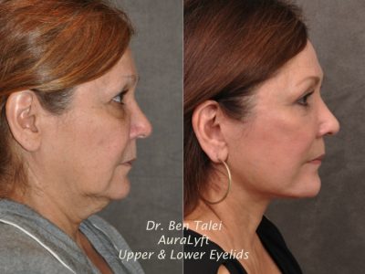 AuraLyft, Upper & Lower Eyelids – Right Side