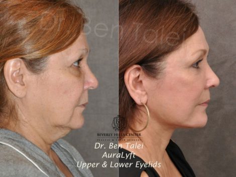 AuraLyft, Upper & Lower Eyelids - Right Side