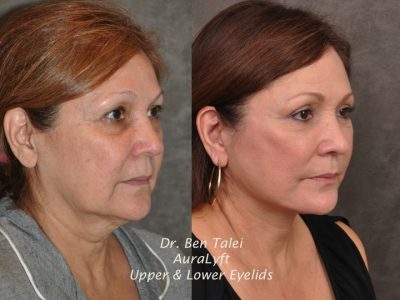 AuraLyft, Upper & Lower Eyelids – Right Side