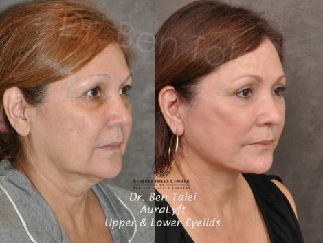 AuraLyft, Upper & Lower Eyelids - Right Side