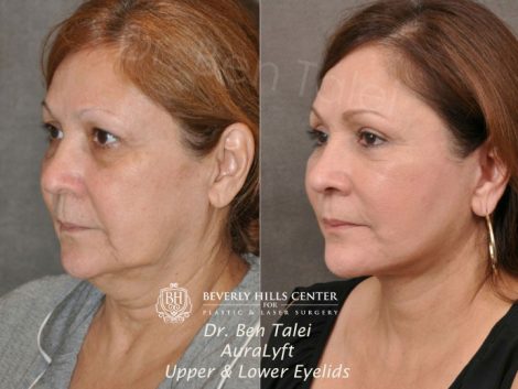 AuraLyft, Upper & Lower Eyelids - Left Side