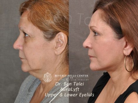 AuraLyft, Upper & Lower Eyelids - Left Side