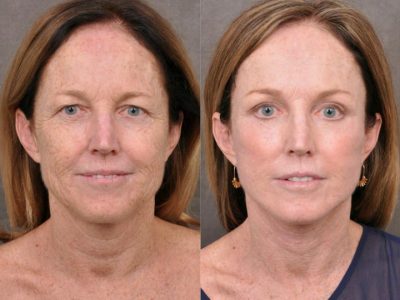 AurLyft, BrowLift, Eyelid Rejuvenation, Profound & CO2