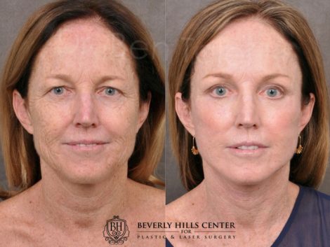 AurLyft, BrowLift, Eyelid Rejuvenation, Profound & CO2 - Front