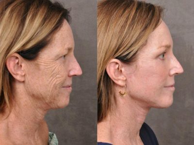 AurLyft, BrowLift, Eyelid Rejuvenation, Profound & CO2