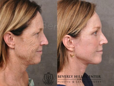 AurLyft, BrowLift, Eyelid Rejuvenation, Profound & CO2 - Right Side