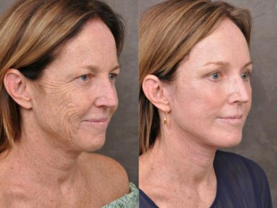 AurLyft, BrowLift, Eyelid Rejuvenation, Profound & CO2