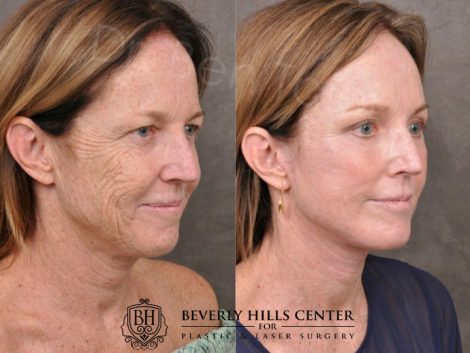 AurLyft, BrowLift, Eyelid Rejuvenation, Profound & CO2 - Right Side