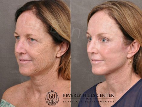 AurLyft, BrowLift, Eyelid Rejuvenation, Profound & CO2 - Left Side