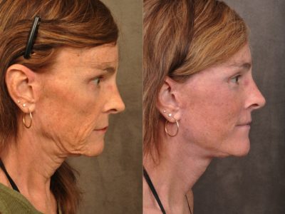 AuraLyft Revision – Transgender - Right Side