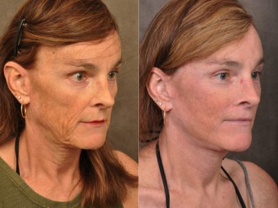 AuraLyft Revision – Transgender - Right Side