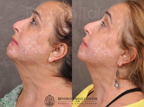 Beverly Hills Center Female Patient Before and After Face and Neck Chemical Burn Contracture Modulation