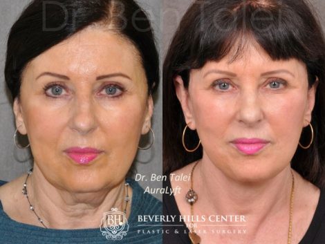 Beverly Hills Center Female Patient Before and After AuraLyft Procedure