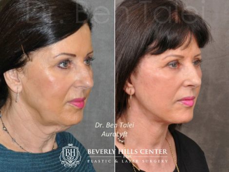 Beverly Hills Center Female Patient Before and After AuraLyft Procedure
