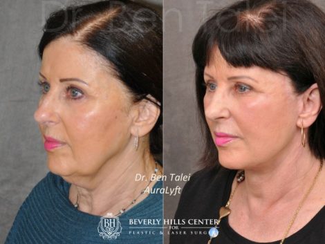 Beverly Hills Center Female Patient Before and After AuraLyft Procedure