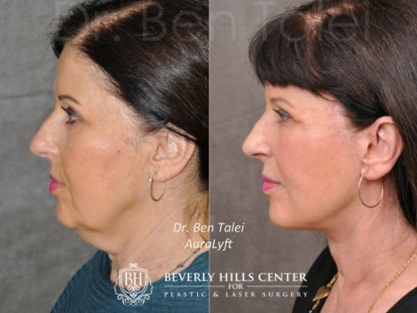 Beverly Hills Center Female Patient Before and After AuraLyft Procedure