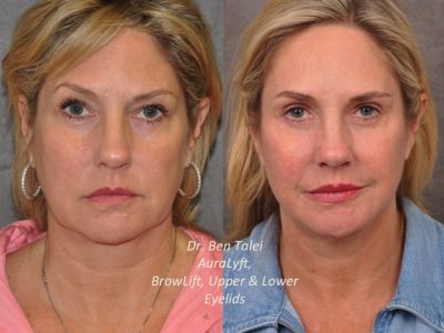 AuraLyft, BrowLift, Upper & Lower Eyelids – Front
