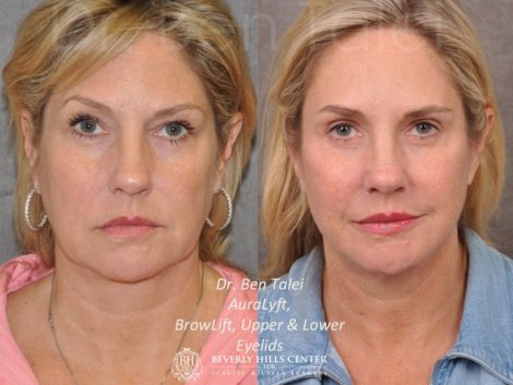 AuraLyft, BrowLift, Upper & Lower Eyelids - Front