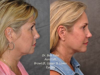 AuraLyft, BrowLift, Upper & Lower Eyelids – Right Side