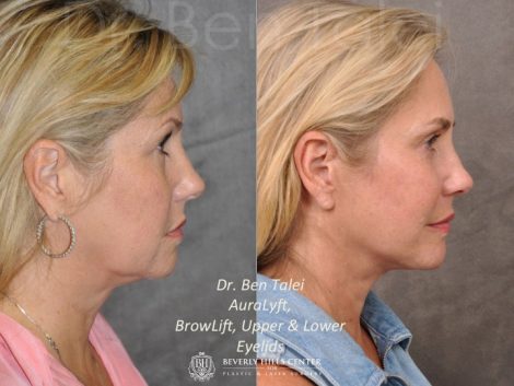 AuraLyft, BrowLift, Upper & Lower Eyelids - Right Side