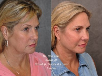 AuraLyft, BrowLift, Upper & Lower Eyelids – Right Side