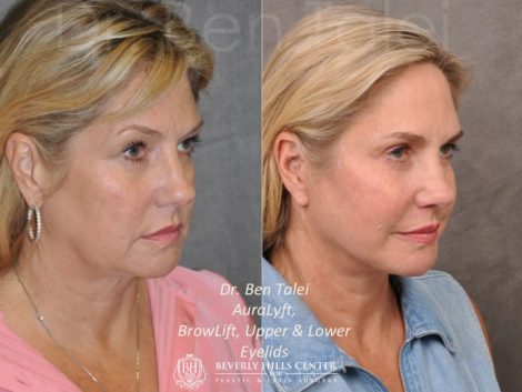 AuraLyft, BrowLift, Upper & Lower Eyelids - Right Side