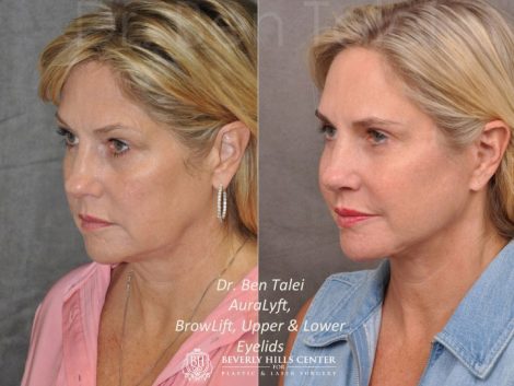 AuraLyft, BrowLift, Upper & Lower Eyelids - Left Side