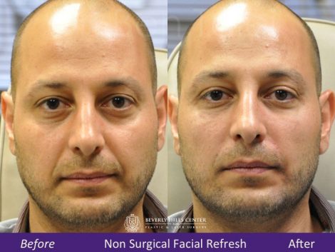 Beverly Hills Center Male Patient Before and After Non-surgical Facial Rejuvenation Procedure
