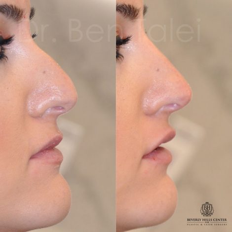 Beverly Hills Center Female Patient Before and After Non-surgical Rhinoplasty Procedure