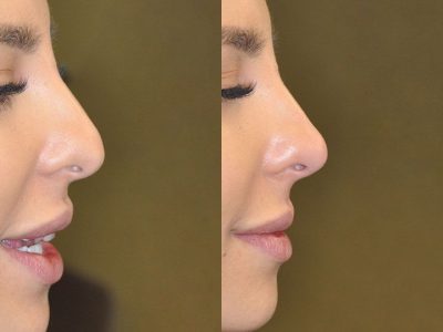 Non Surgical Rhinoplasty / Liquid Nosejob