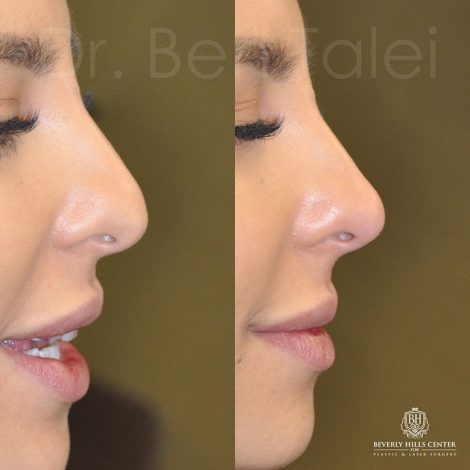 Beverly Hills Center Female Patient Before and After Non-surgical Rhinoplasty Procedure