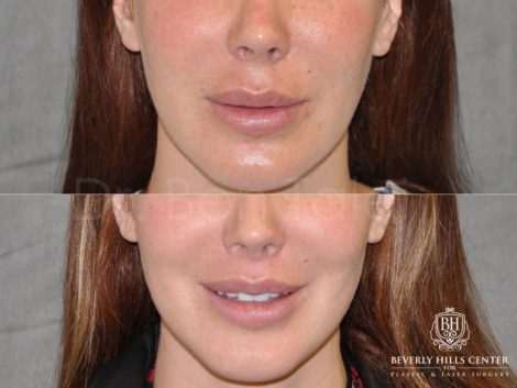 Modified Upper Lip Lift - Front
