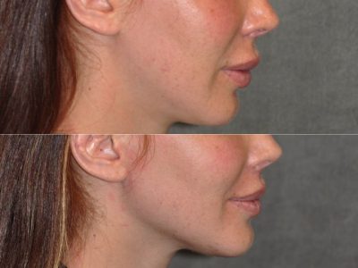 Modified Upper Lip Lift - Right Side