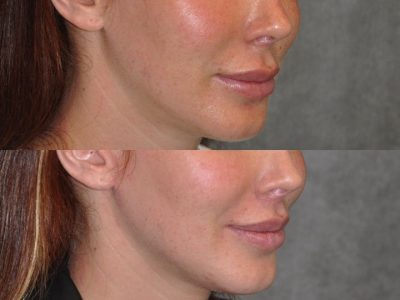 Modified Upper Lip Lift - Right Side