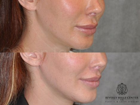 Modified Upper Lip Lift - Right Side