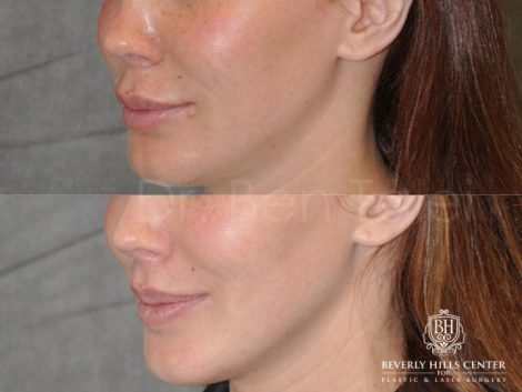 Modified Upper Lip Lift - Left Side