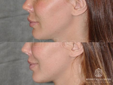 Modified Upper Lip Lift - Left Side