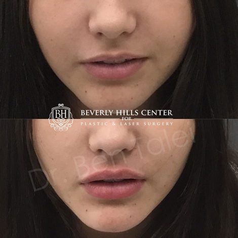 Beverly Hills Center Female Patient Before and After Lip Injection Procedure